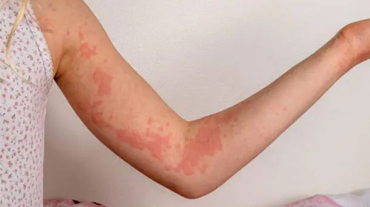 ¿Cómo evitar las picaduras de chinches?