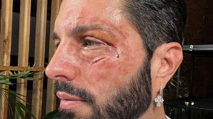 ¿Qué le pasó a Poncho de Nigris? Esta es la razón por la que apareció con el rostro golpeado