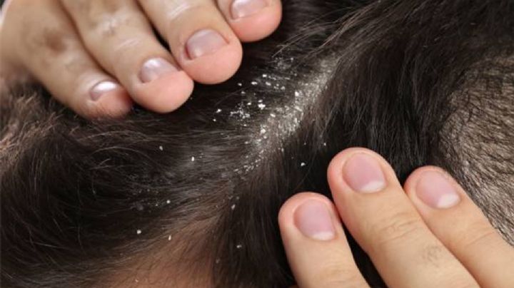 ¿Cómo eliminar la caspa con aloe vera?