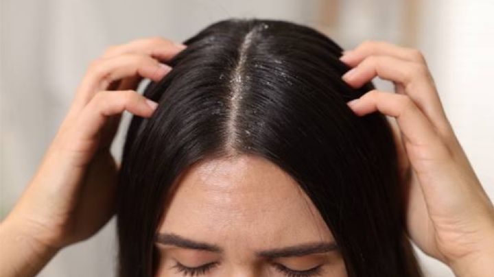 Esta es la planta medicinal que elimina la caspa y detiene la caída del cabello