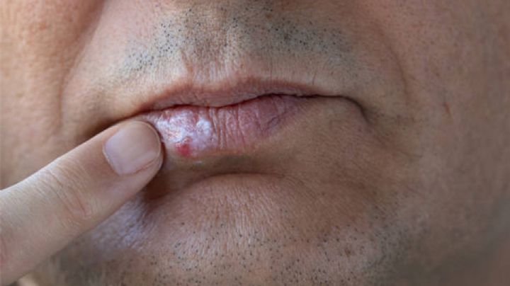Los mejores remedios para eliminar un fuego labial